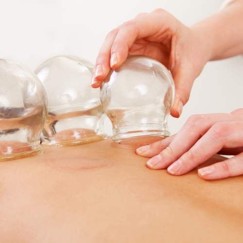 Cupping-PacificPro-Physical-Therapy-&-Sports-Medicine-California-Murfreesboro-TN