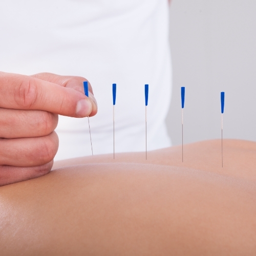 Dry-Needling-PacificPro-Physical-Therapy-&-Sports-Medicine-California-Murfreesboro-TN