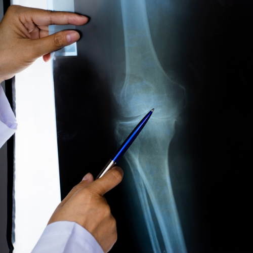Fractures-PacificPro-Physical-Therapy-&-Sports-Medicine-California-Murfreesboro-TN